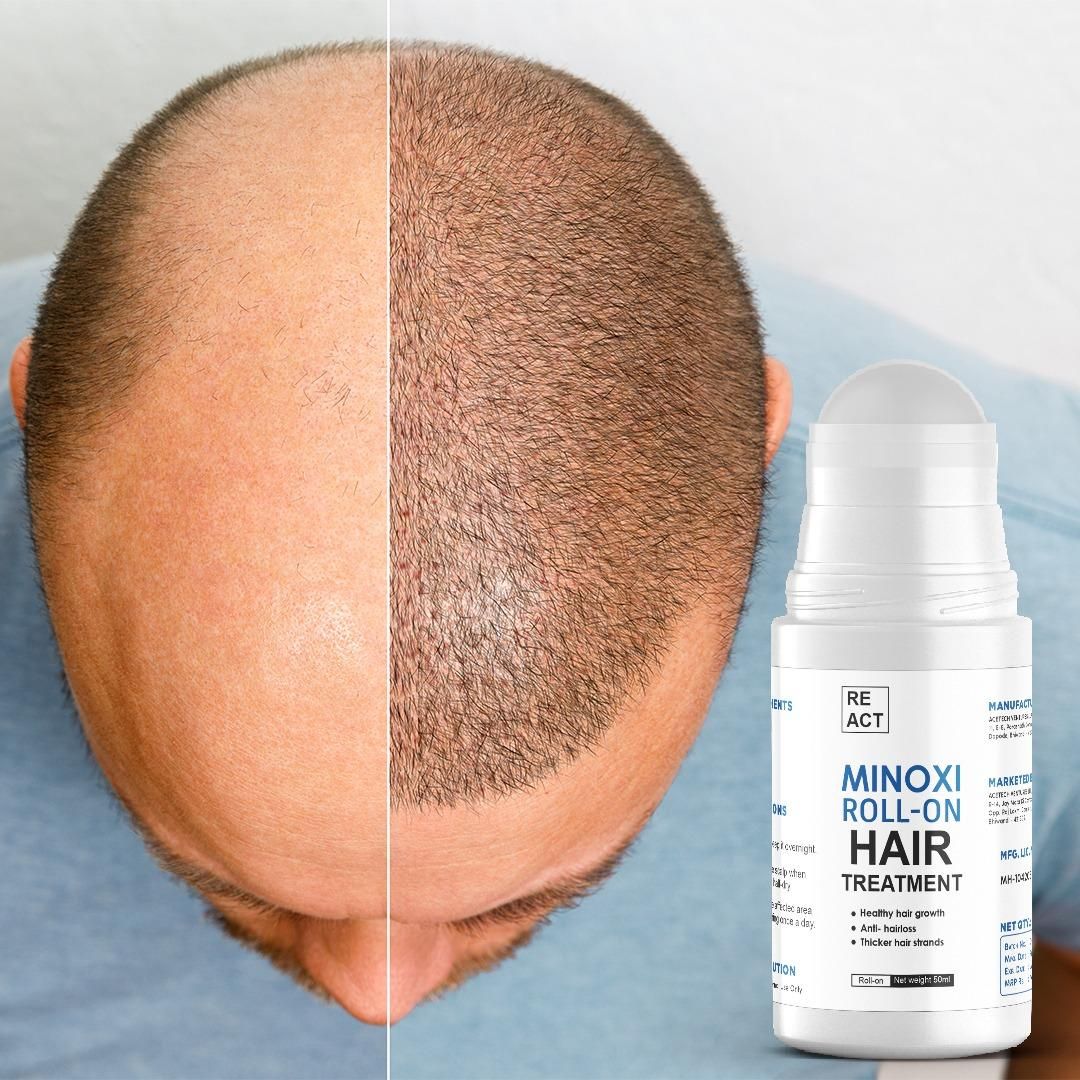 Minoxi Roll-On Hair Treatment Serum 🌿💆‍♂️💆‍♀️